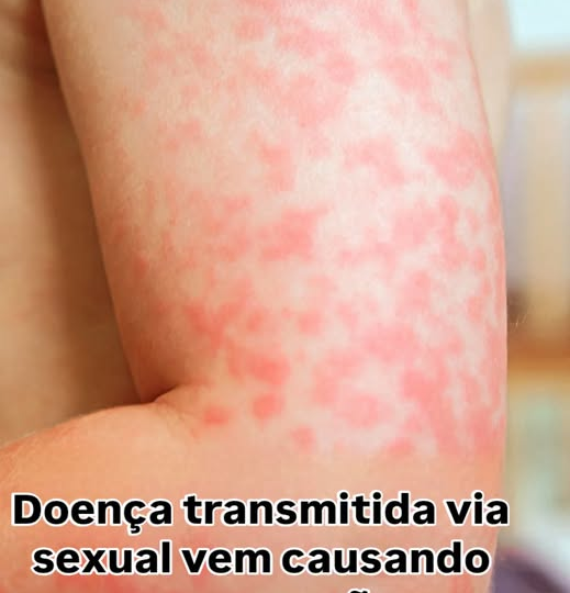 Depois do Carnaval, o alerta é para ISTs e infecções fúngicas