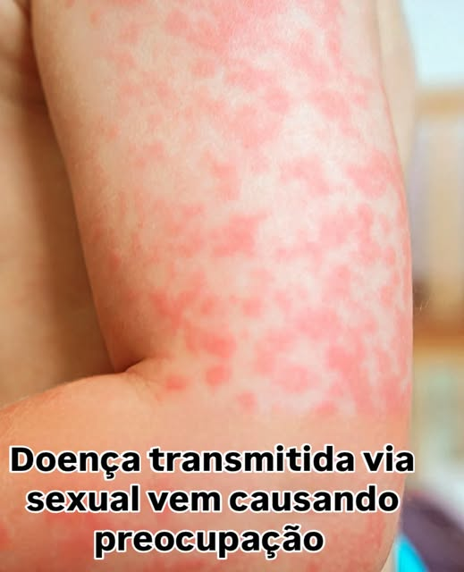 Depois do Carnaval, o alerta é para ISTs e infecções fúngicas