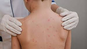 ALERTA: CASOS RECENTES DE MENINGITE ACENDEM SINAL VERMELHO NO BRASIL